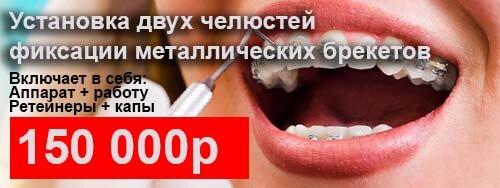 Установка 2х челюстей фиксации металлических брекетов-150000