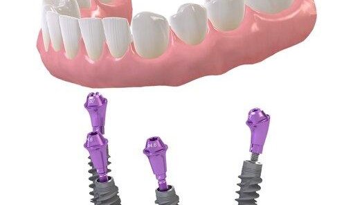 Восстановить все зубы в челюсти на 4х имплантатах от 138тыс.