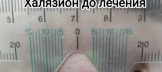 Халязион верхнего и нижнего века