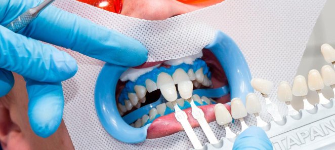 Клиническое отбеливание зубов всего 15 000 рублей