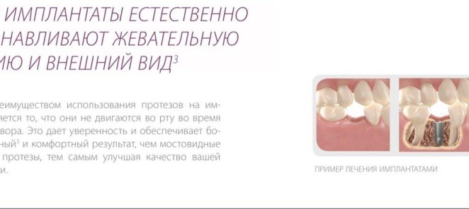 Швейцарский имплантант Neodent 35000 рублей
