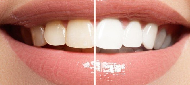 Отбеливание зубов всего 7600 рублей🦷