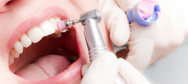 Скидка 15% на гигиену полости рта перед имплантацией зубов