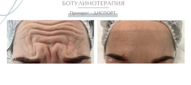 Коррекция мимических морщин препаратом Диспорт - 120₽