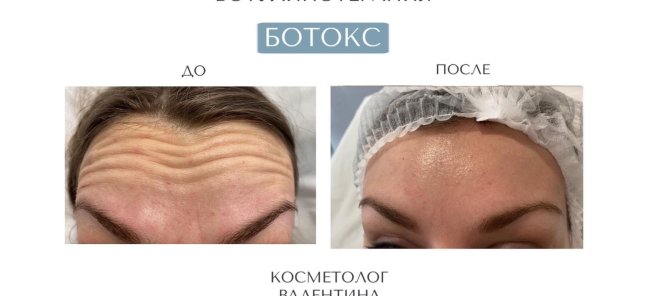 Коррекция мимических морщин препаратом Ботулакс
