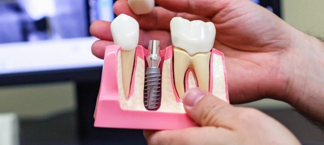 Имплантация зубов одномоментная и поэтапная.
