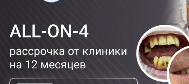 Рассрочка на All-on-4