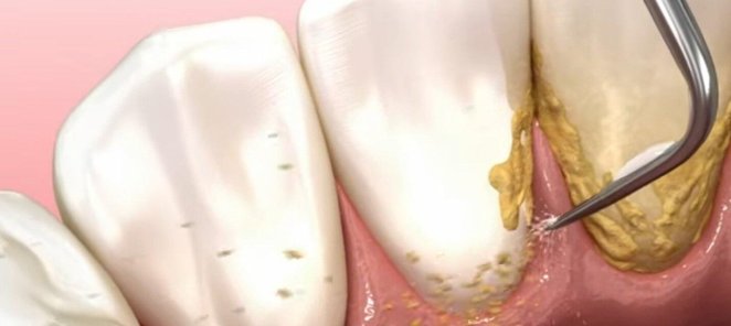 Чистка зубов+фторирование – 2000 руб
