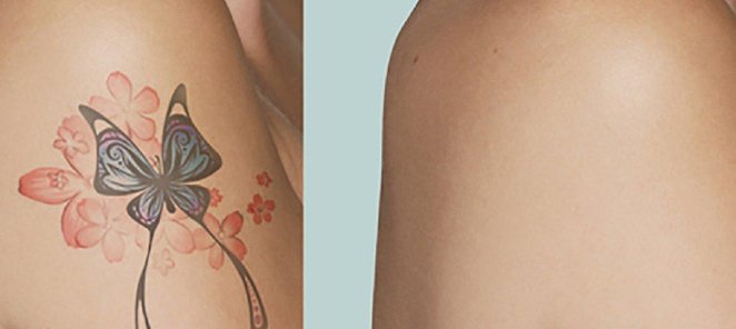 Плазменное удаление татуировок