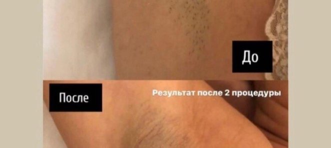 Лазерная эпиляция малой зоны БЕСПЛАТНО!