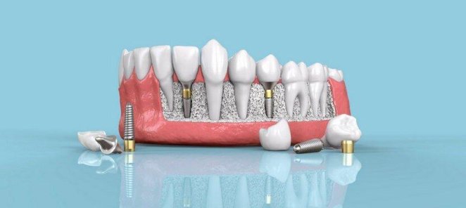 Премиальная имплантация зубов Dentium под ключ за 38 500