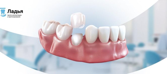 Коронка из диоксида циркония со скидкой 10%