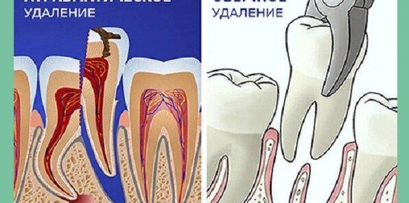 Лучшее предложение Атравматическое удаление зубов