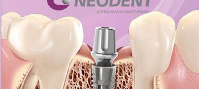 Установка имплантата Neodent с циркониевой коронкой за 57900