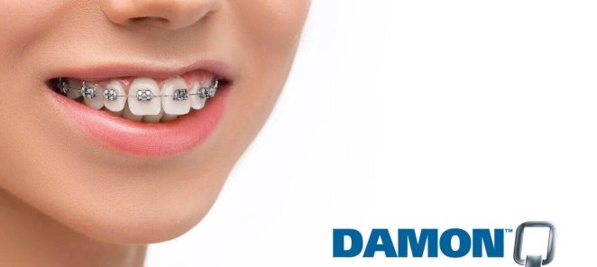 Брекет-система Damon Q на одну челюсть 40.000 ₽