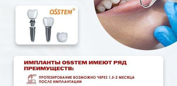 Имплантация Osstem