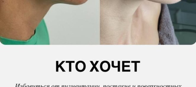 Удаление пигментации