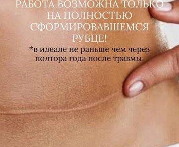 Камуфляж растяжек, рубцов, шрамов. Без боли!!!