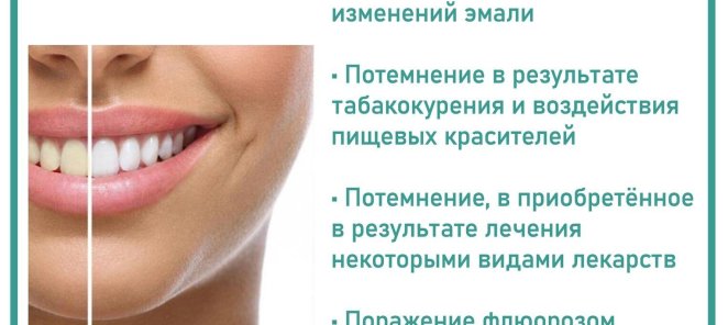 Профессиональное отбеливание зубов