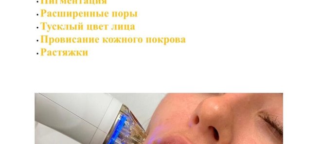 Микроигольчатый RF -лифтинг на аппарате FACE SCULPT