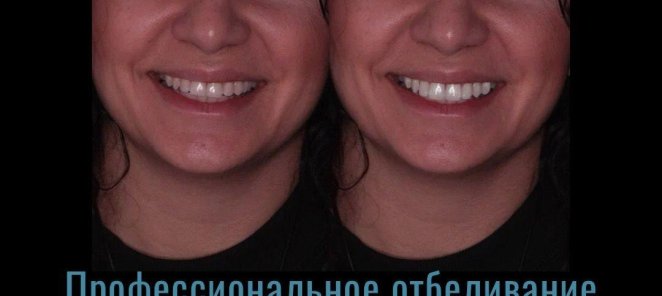 Профессиональное отбеливание