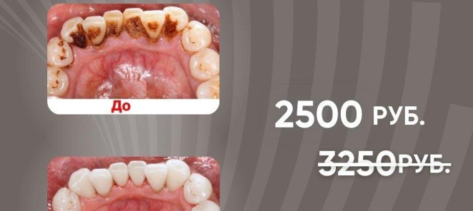 АКЦИЯ! Профессиональная гигиена полости рта за 2 500 руб!
