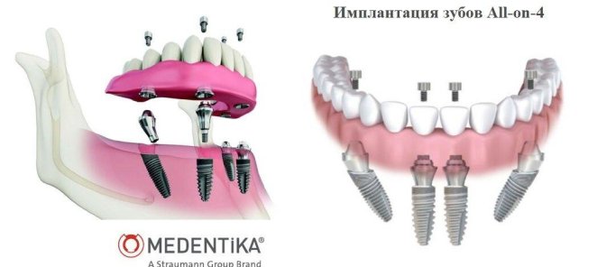 Имплантация зубов All-on-4 (Все на четырех)