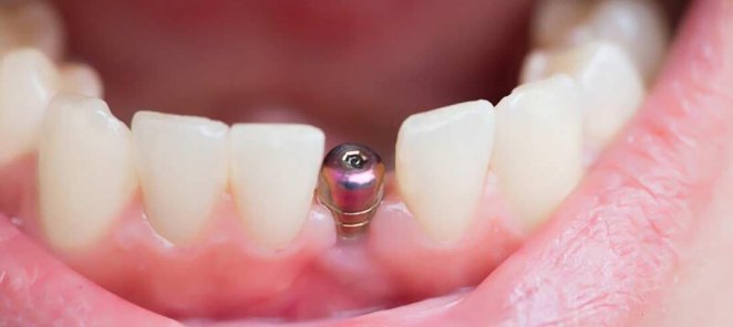 Протезирование зубов в стоматологии Ваш Дантист от 5 300 ₽