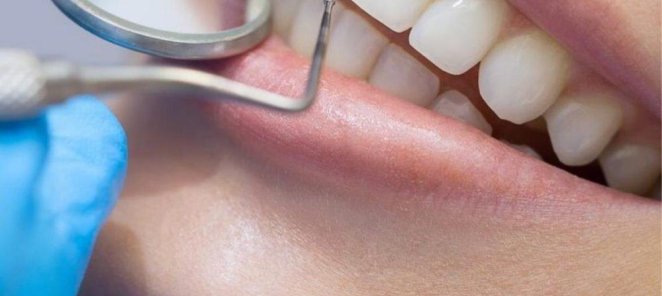 Скидка 10% на лечение зубов