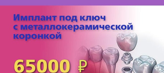 Имплантат 
