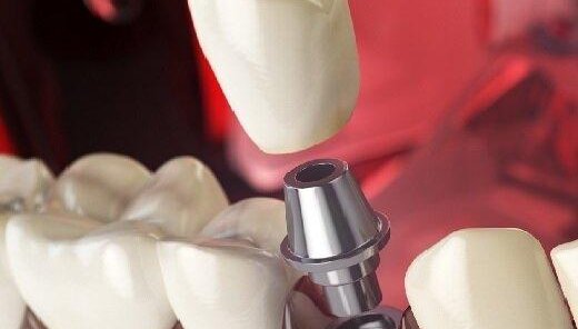 СКИДКА 10% на имплантацию зубов