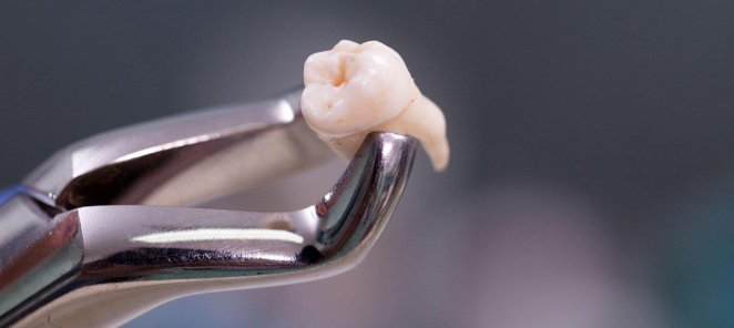 Удаление зуба (простое) + анестезия от 3 490 рублей