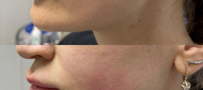 Ultherapy!!! Уникальная процедура SMAS лифтинга!!!
