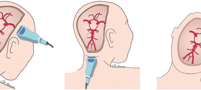 УЗИ сосудов мозга, УЗИ БЦА по цене 1800 руб. вместо 2100 руб