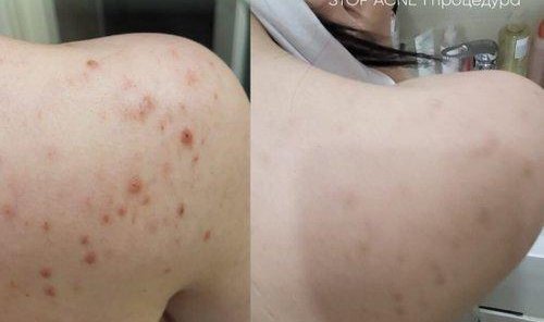 GREEN PEEL® STOP ACNE 6000₽