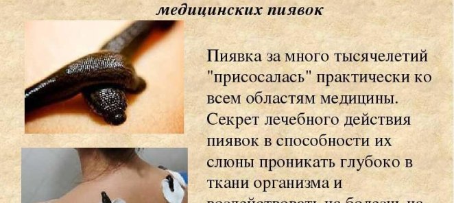 ГИРУДОТЕРАПИЯ — УНИКАЛЬНЫЙ МЕТОД ЛЕЧЕНИЯ