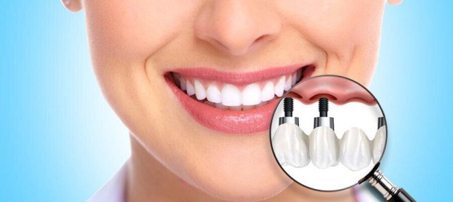 Зубные имплантаты систем Osstem и Dentium.