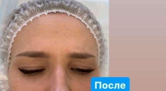 Требуются модели на ботокс! Оплата только за препарат 4500р.
