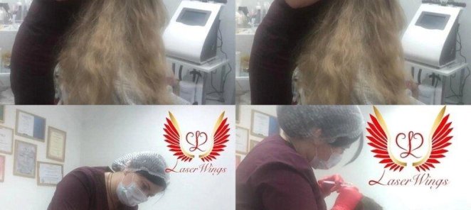 Мезотерапия для волос