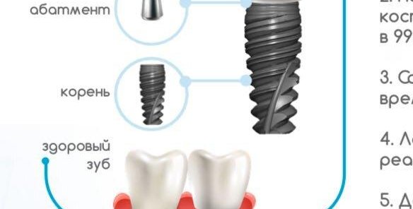Бесшовная имплантация под ключ с коронкой за 49000 рублей!