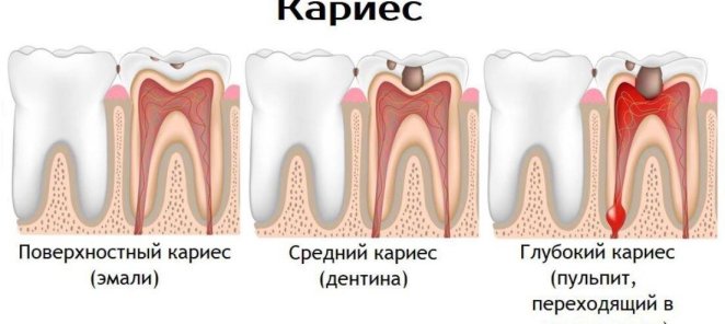ЛЕЧЕНИЕ КАРИЕСА от 3000 р