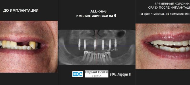 All-on-4 и All-on-6 протезирование без переплат