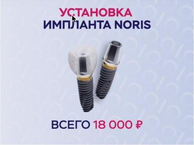 Установка импланта Noris Medical (Израиль) - 18000 руб.