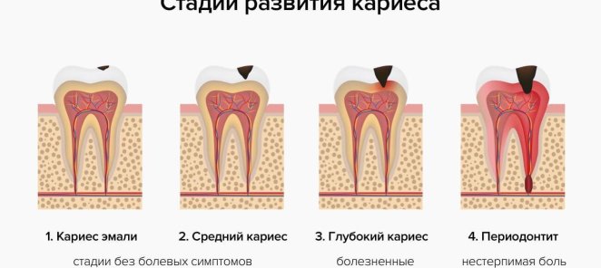 Лечение кариеса