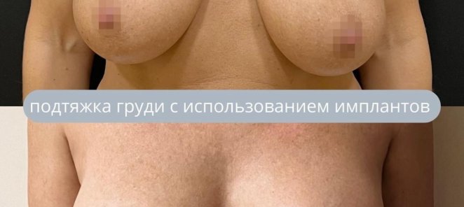 Увеличение груди по специальной цене