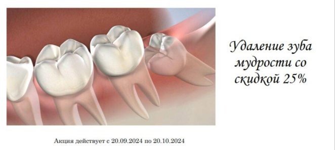 Удаление зуба мудрости со скидкой 25%