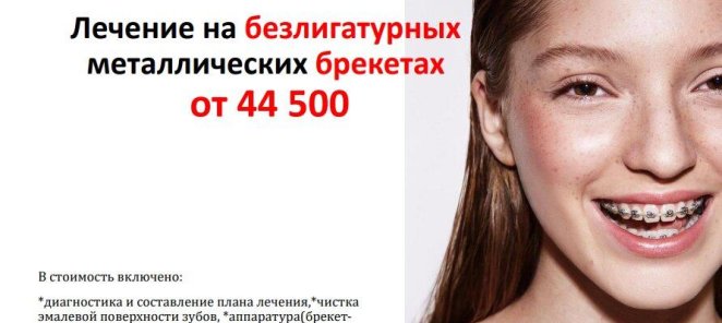 Лечение на безлигатурных металлических брекетах от 44 500 р.