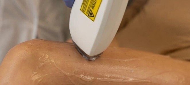 Почему стоит выбрать лазерную эпиляцию?