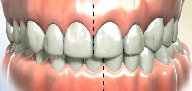 Неправильный прикус: когда улыбка требует внимания?