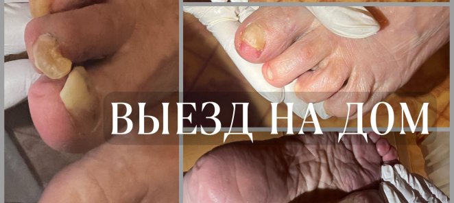 Обработка вросшего ногтя различной степени сложности